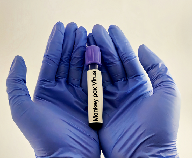 małpia ospa, nowy wariant wirusa mpox w Europie